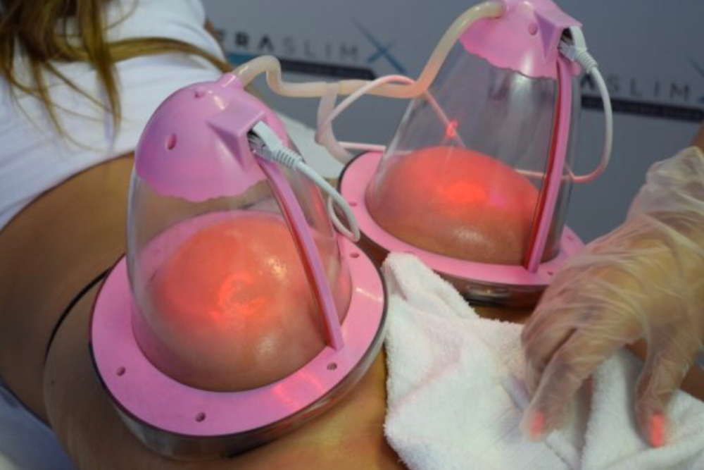 BBL Vacuum Therapy