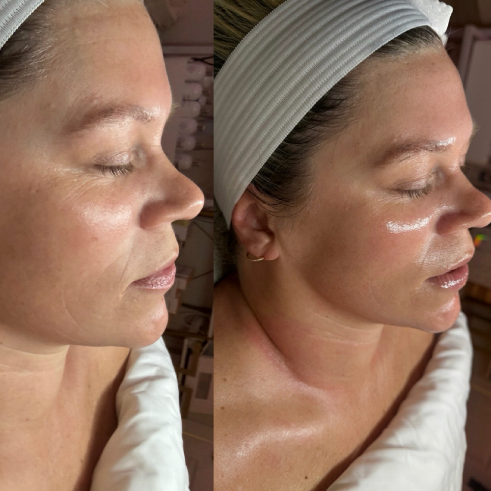 Golden Hour Facial at Tessthetics in Danvers, MA