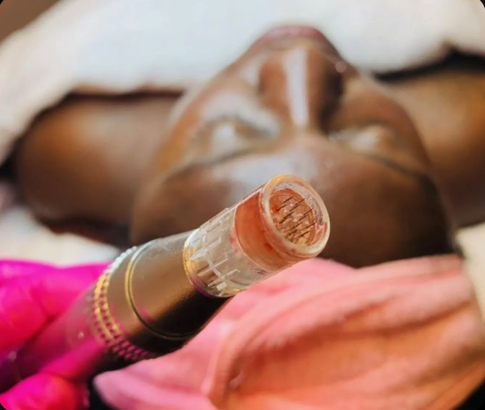 2 Deep In:Mocroneedling + Chem Peel