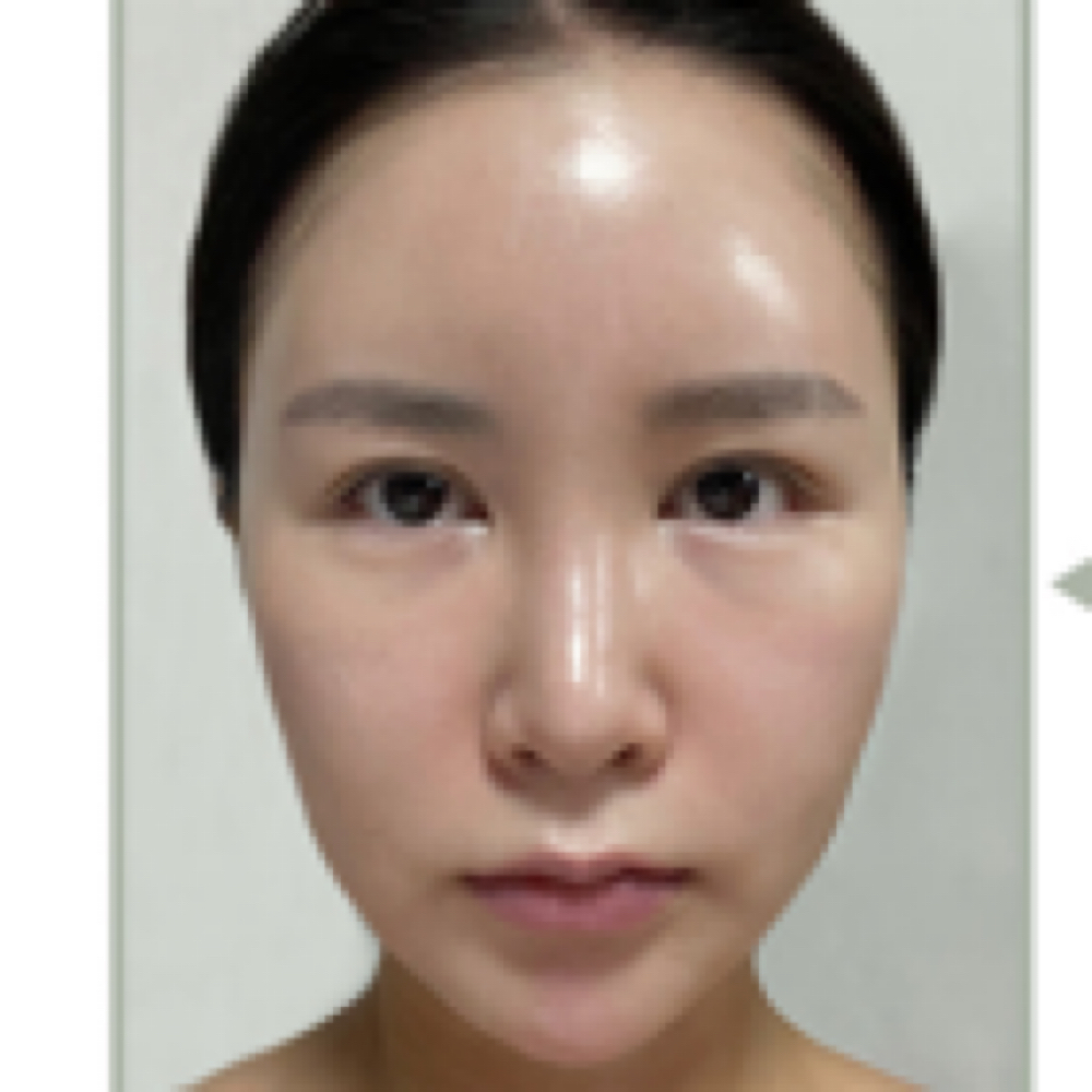 Carboxy Therapy Facial at Nurse Ink/Rao Med Spa in Covington, LA
