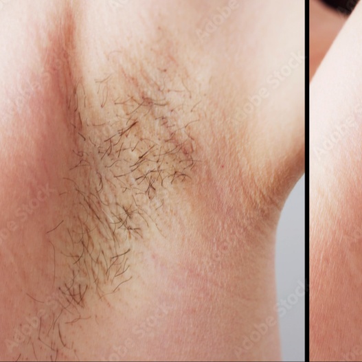 Underarm Wax at Klashed On Main in London, KY