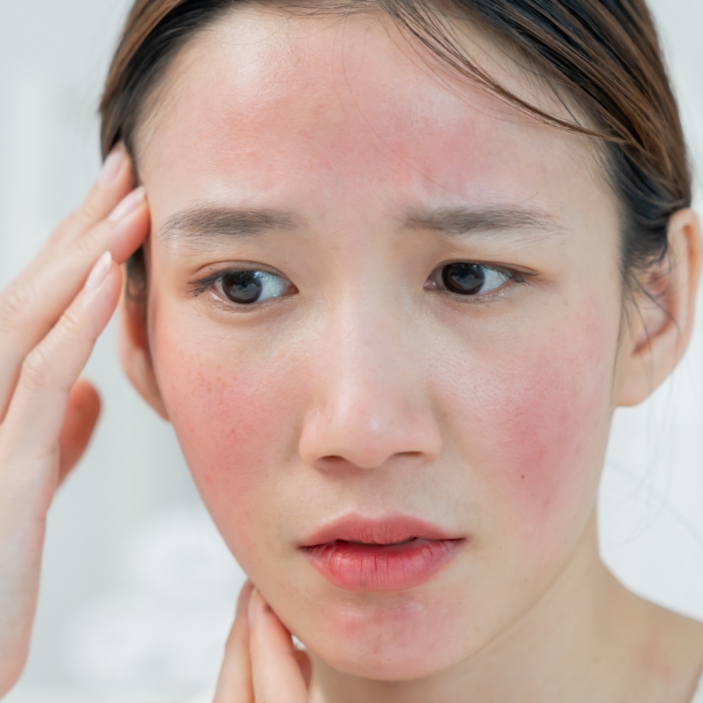 Redness Relief Rosacea Facial at Angel Face Skin Care in Madera, CA