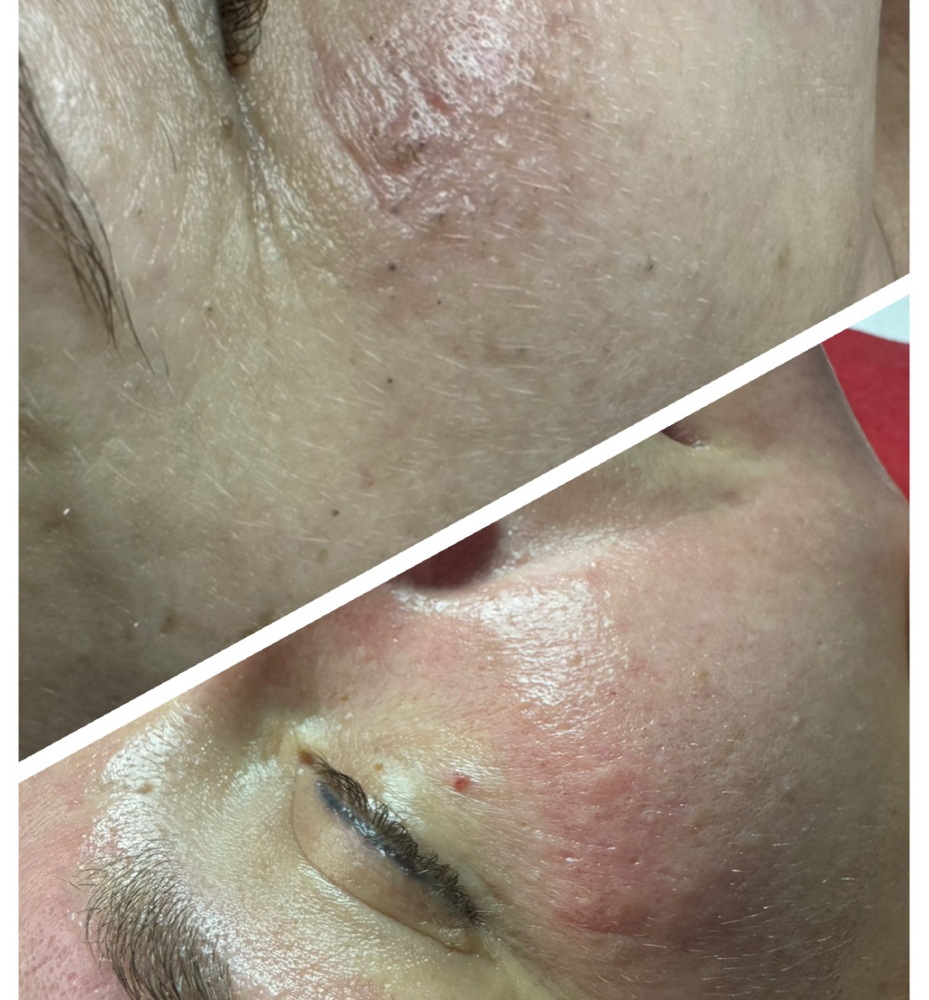 Acne Treatment Facial at Beauty Retreat in mt hope, WV