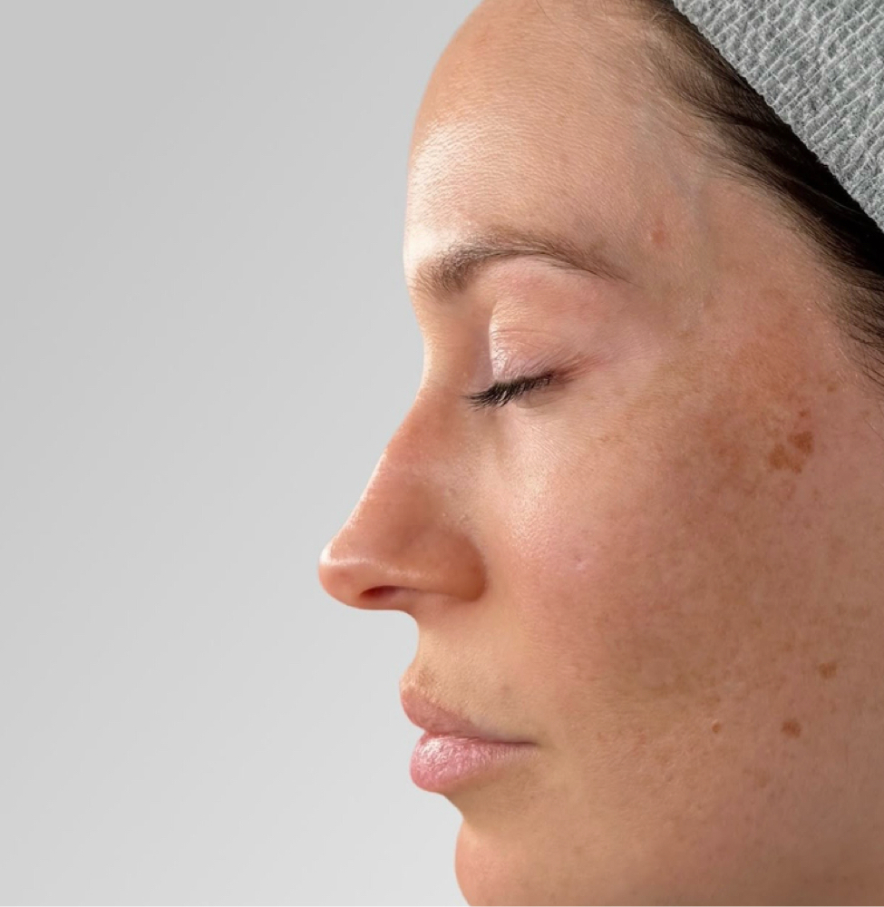 Chemical Peel Mesoestetic at SiempreBellasBeautySpa in North Miami, FL