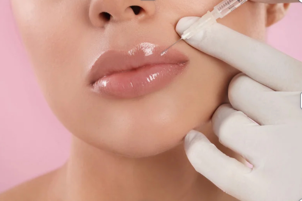 Lip Filler