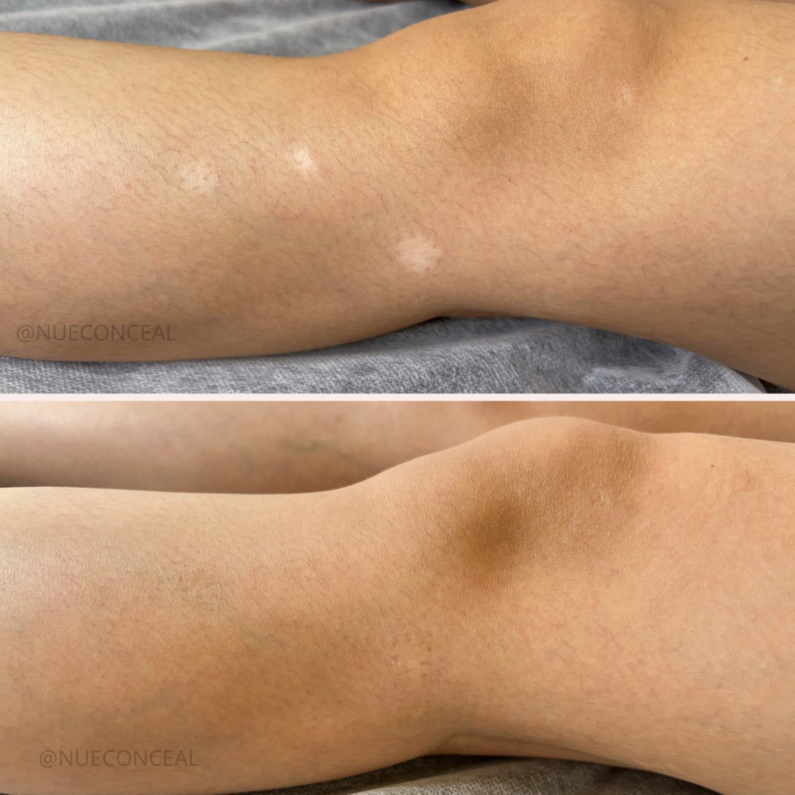 Scar Camouflage Model Call Consult at Beauty by Radiant Strokes in Lakeland, FL
