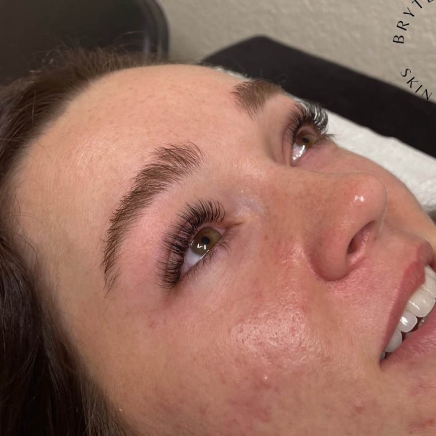 3 Week Classic Fill at Bryten Gilliam Aesthetics in Brock, TX