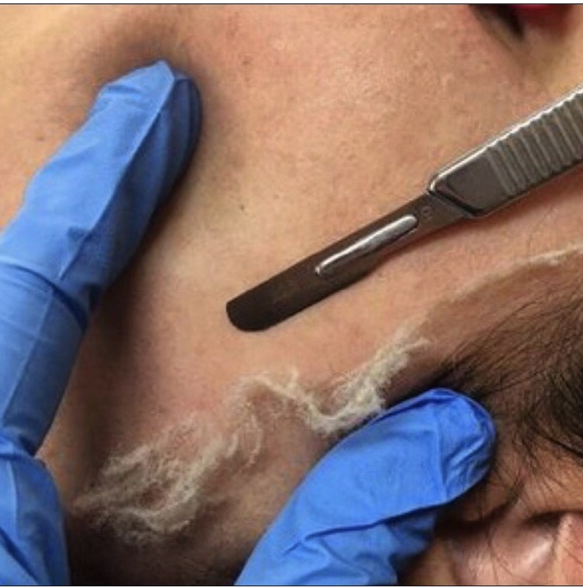DERMAPLANE