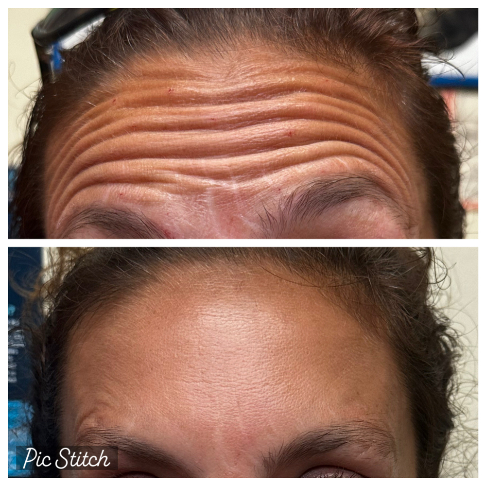 Forehead/ Frontalis at SCL Aesthetics in Putnam, CT