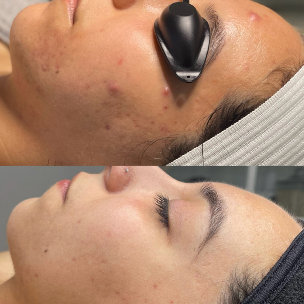 ACNE TREATMENT at Czerinaesthetics, LLC in San Antonio, TX