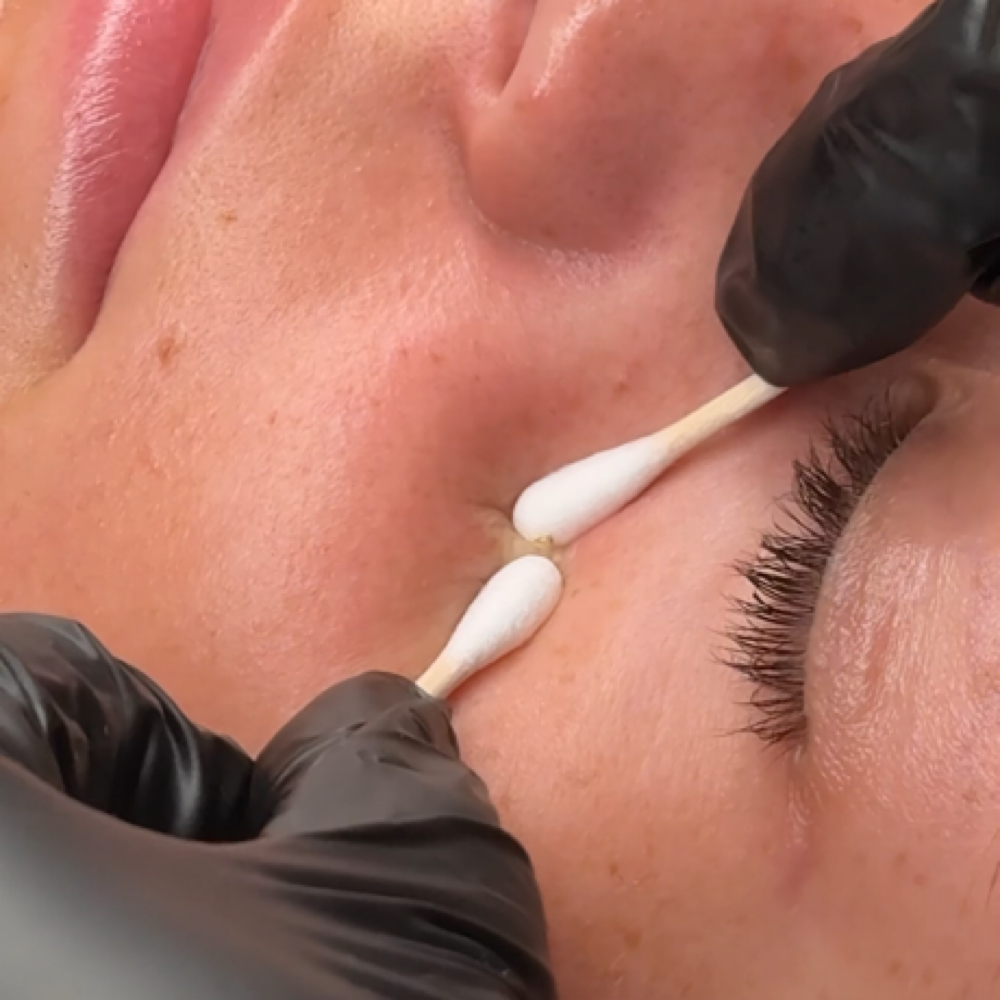 Extractions Add-On at Skylar Ashley Aesthetics in Leitchfield, KY