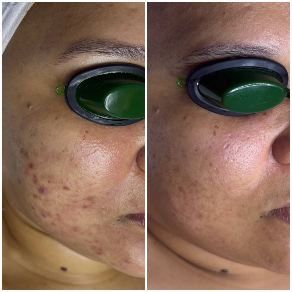 Acne Clarifying Facial at Ann Jay Skin & Body in Clifton, NJ