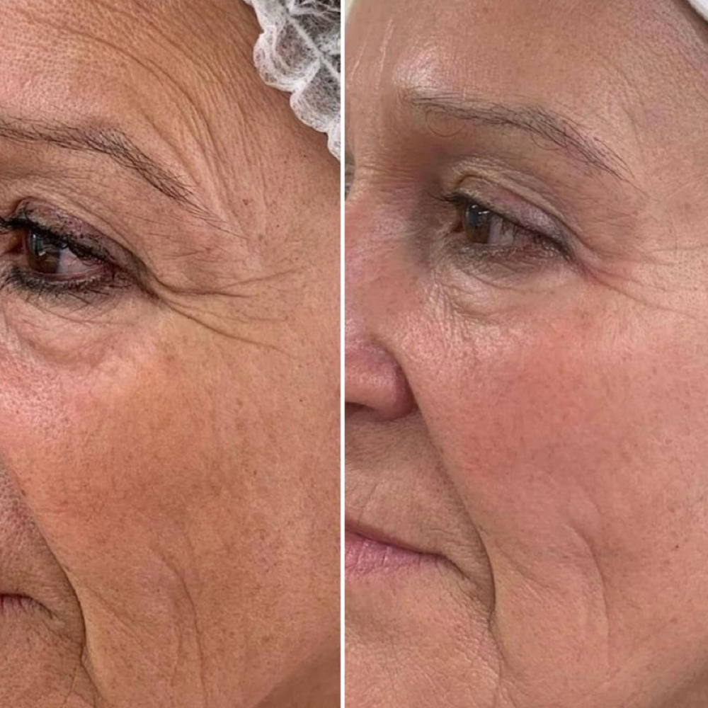 hyaluronic Acid Skin Booster at Radiant Beauty & Jewelry in Laramie, WY
