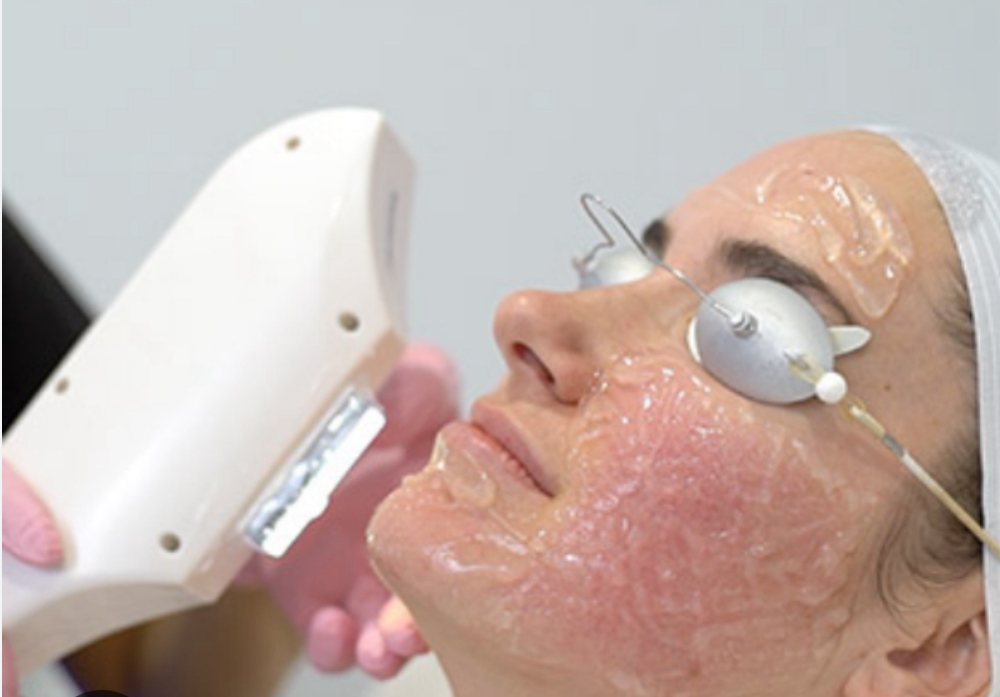 IPL facial treatment