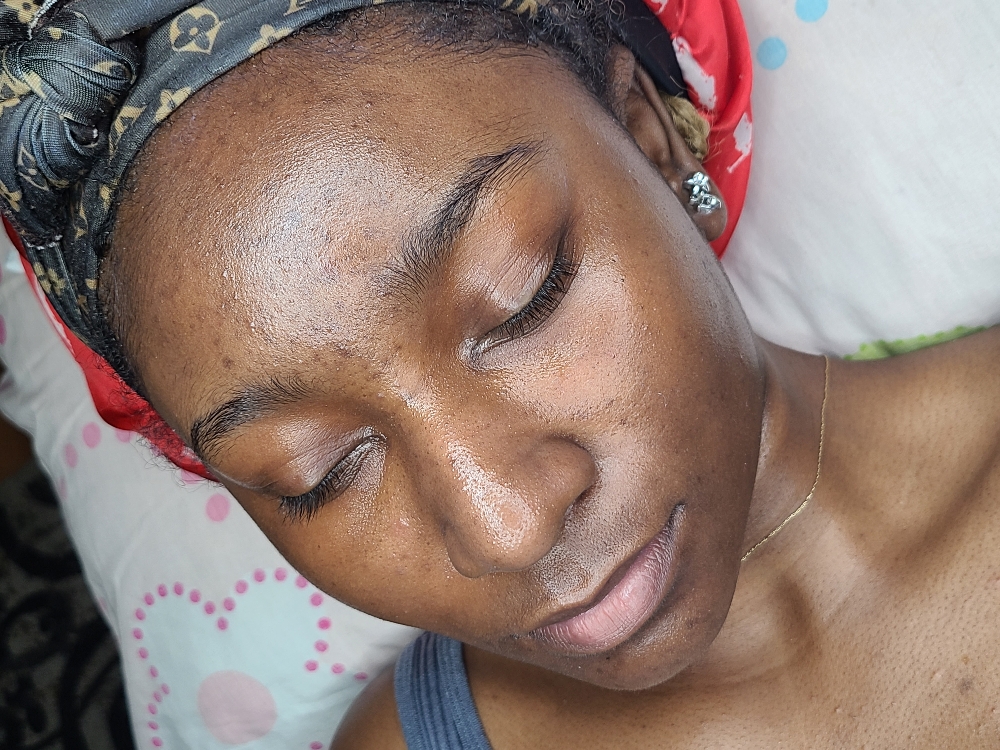 Acne Facial