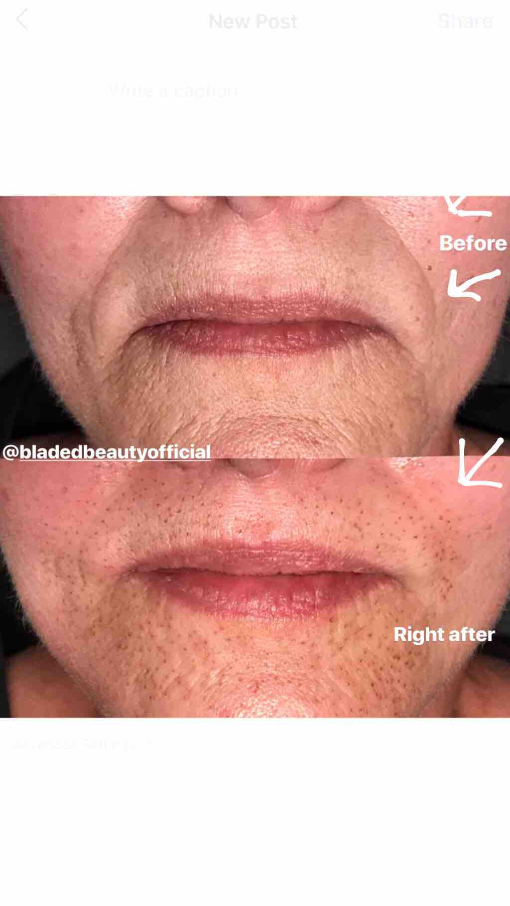 Lip Lines (Fine Lines Around Mouth)