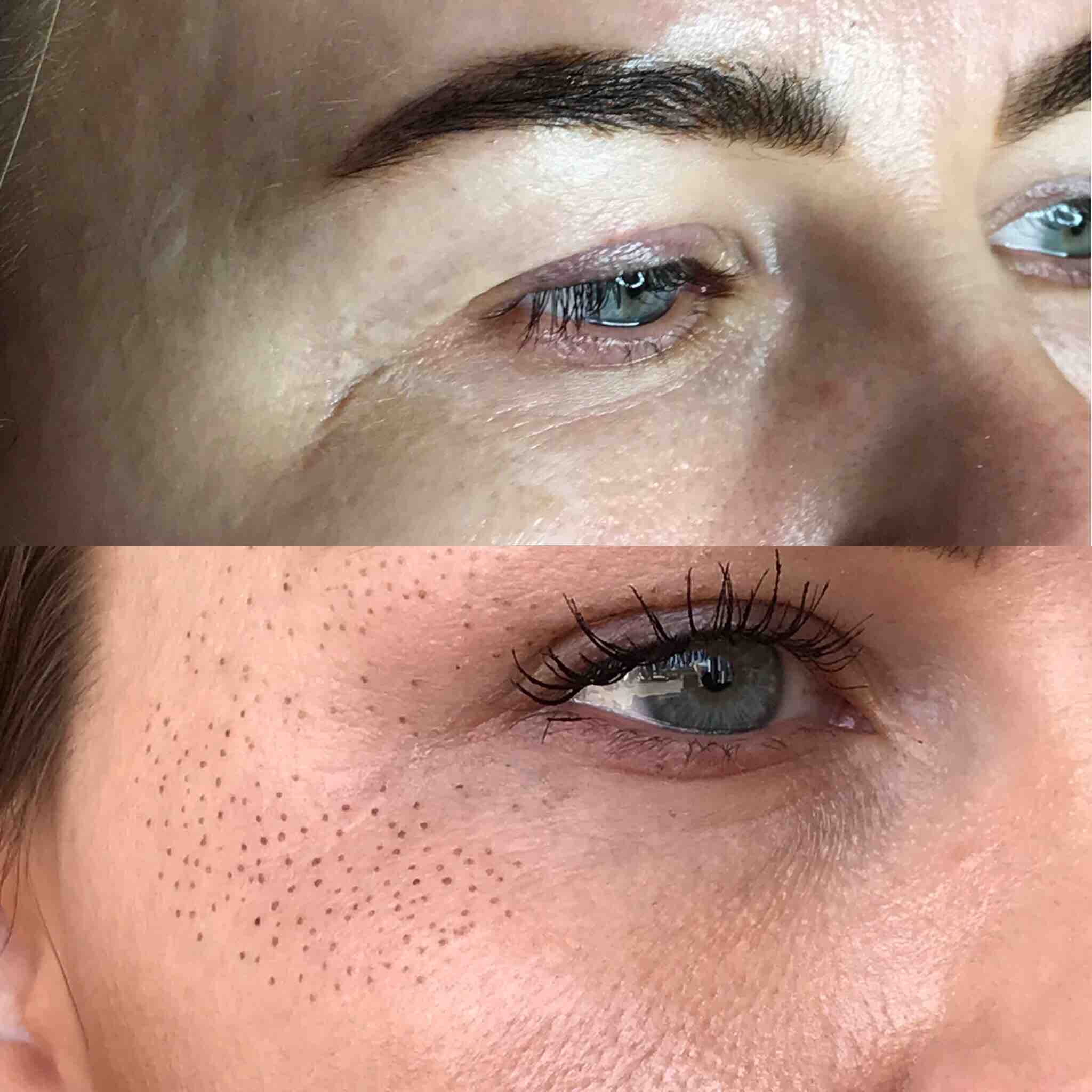 Upper Eyelids  (lift/tighten)