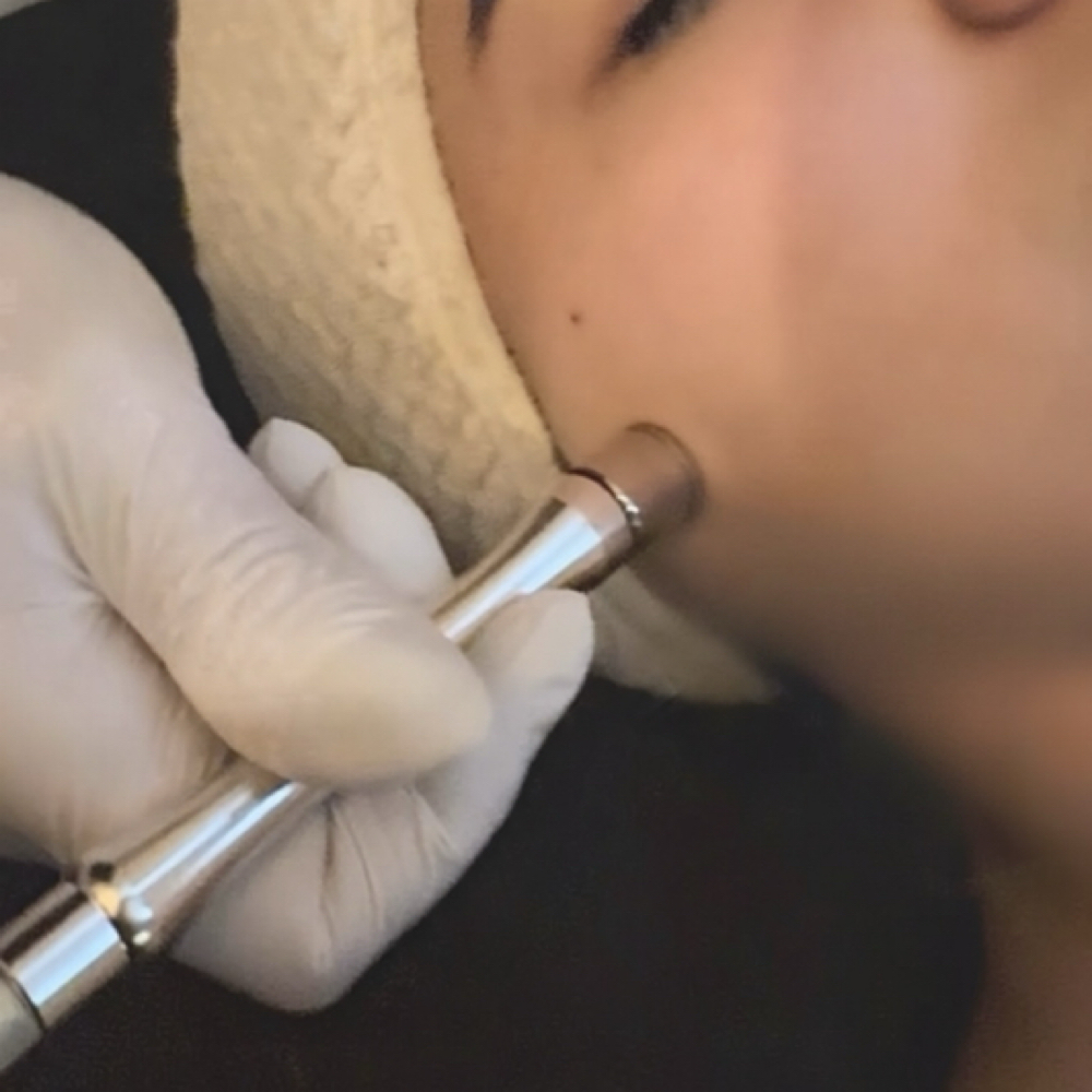 Signature Glow + Microdermabrasion at Uncommon Esthetics in Rancho Cucamonga, CA