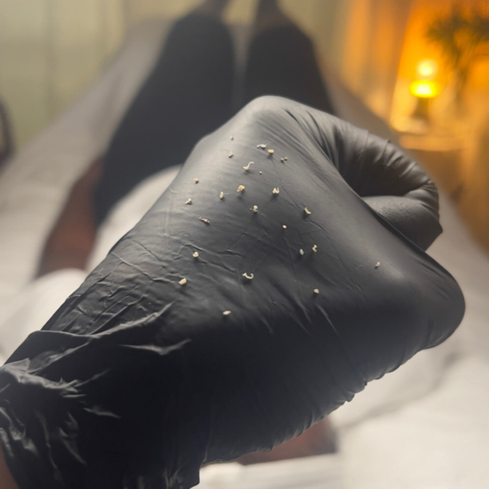 Extraction (Spot Treat) at Complexion Therapy in Kennewick, WA