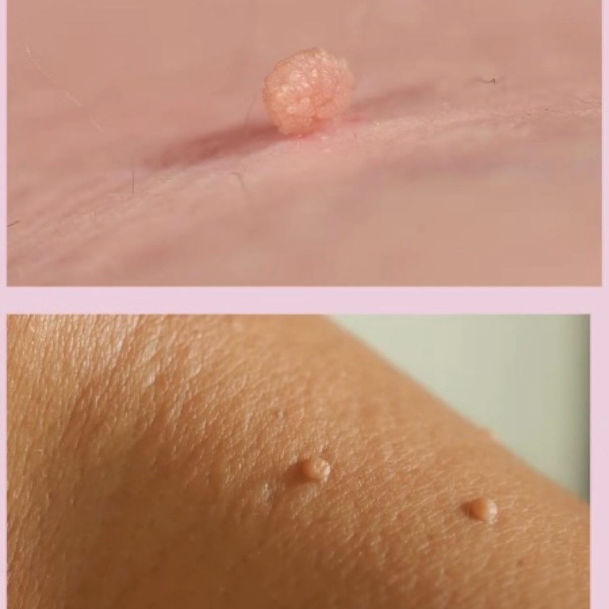 Skin Tag Removal at Serenity Aesthetics by Denise in St. John’s, FL