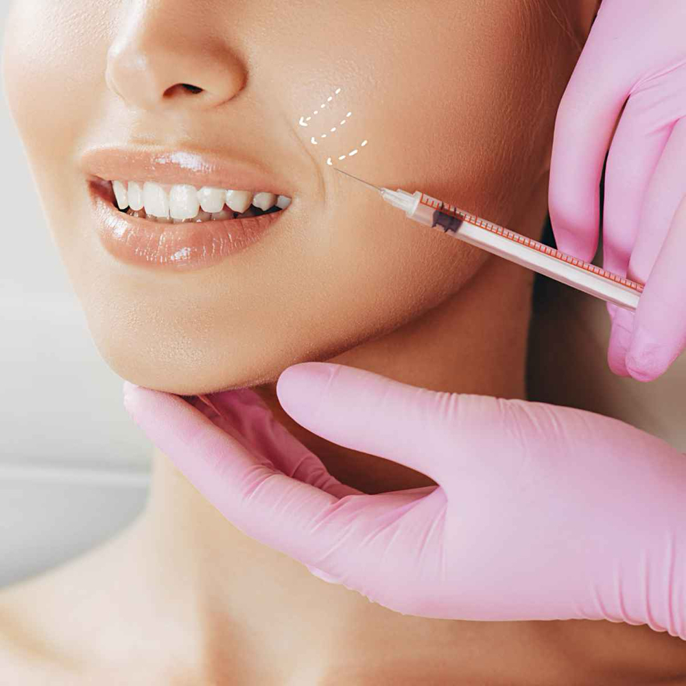 Nasolabial Filler (Surcos nasog)