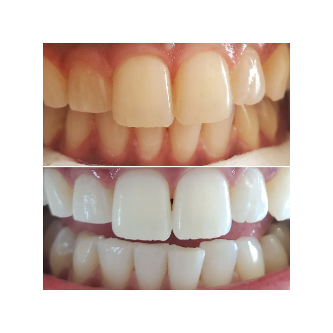 Teeth Whitening