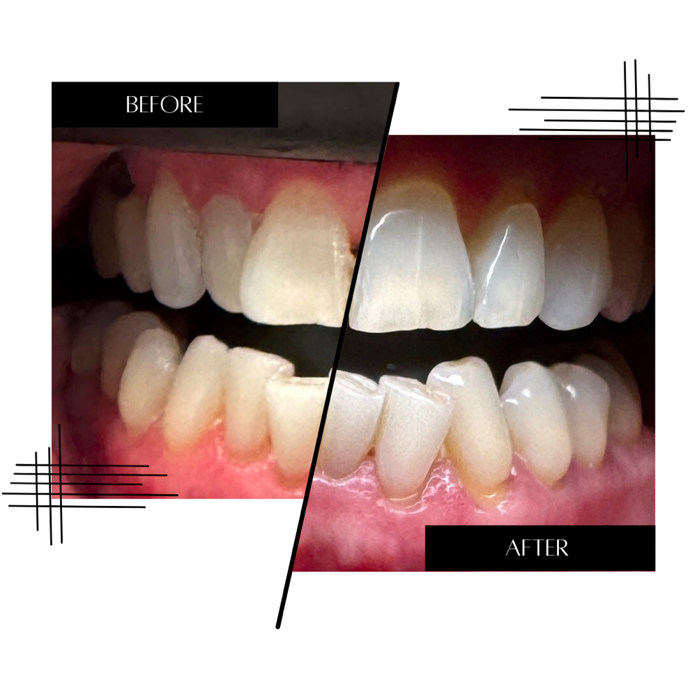Teeth Whitening at The Beauty Spot by Meredith in Freehold, NJ