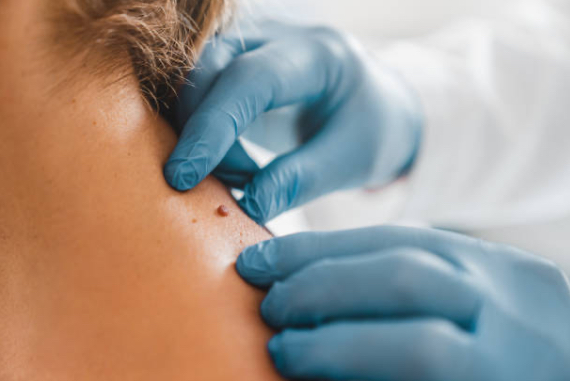 Skin Tag Removal