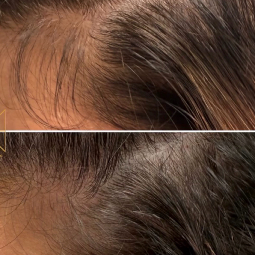 Secret Sauce Hair Restoration at Aesthetic NP Marie in Portland, OR
