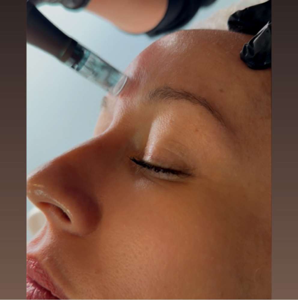 Microneedling Treatment at Luxury Lash & Skincare in Norwood, MA