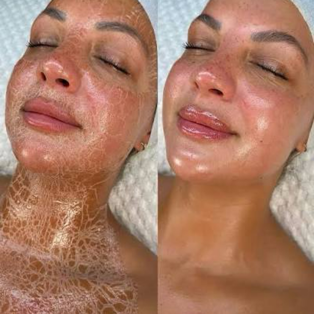 Glowtox Facial at True Skin By Lis in Ventura, CA