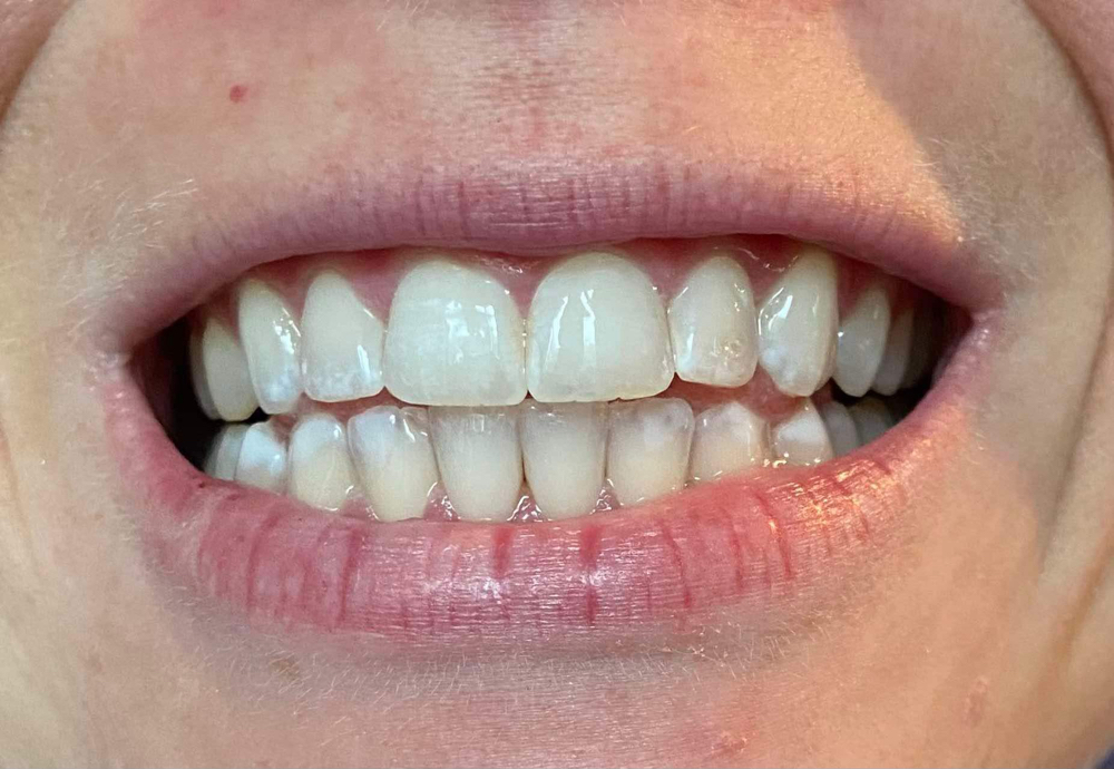 Teeth Whitening