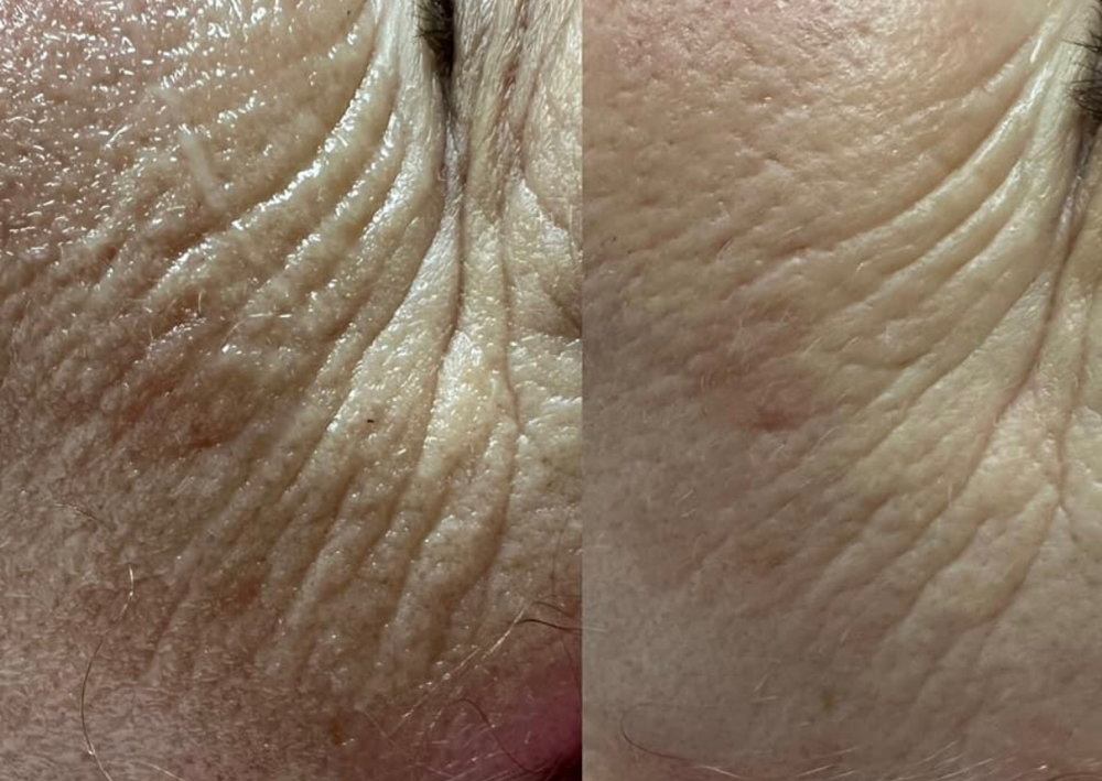 Collagen Induction Therapy