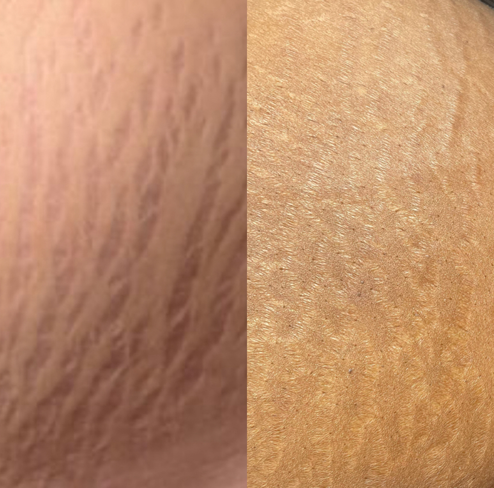 Inkless Stretch Mark Revision