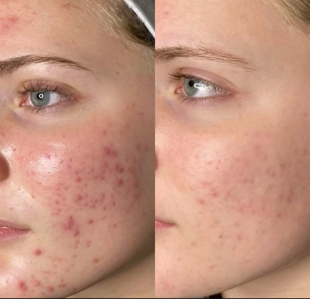 Oxygen RX Glow Facial