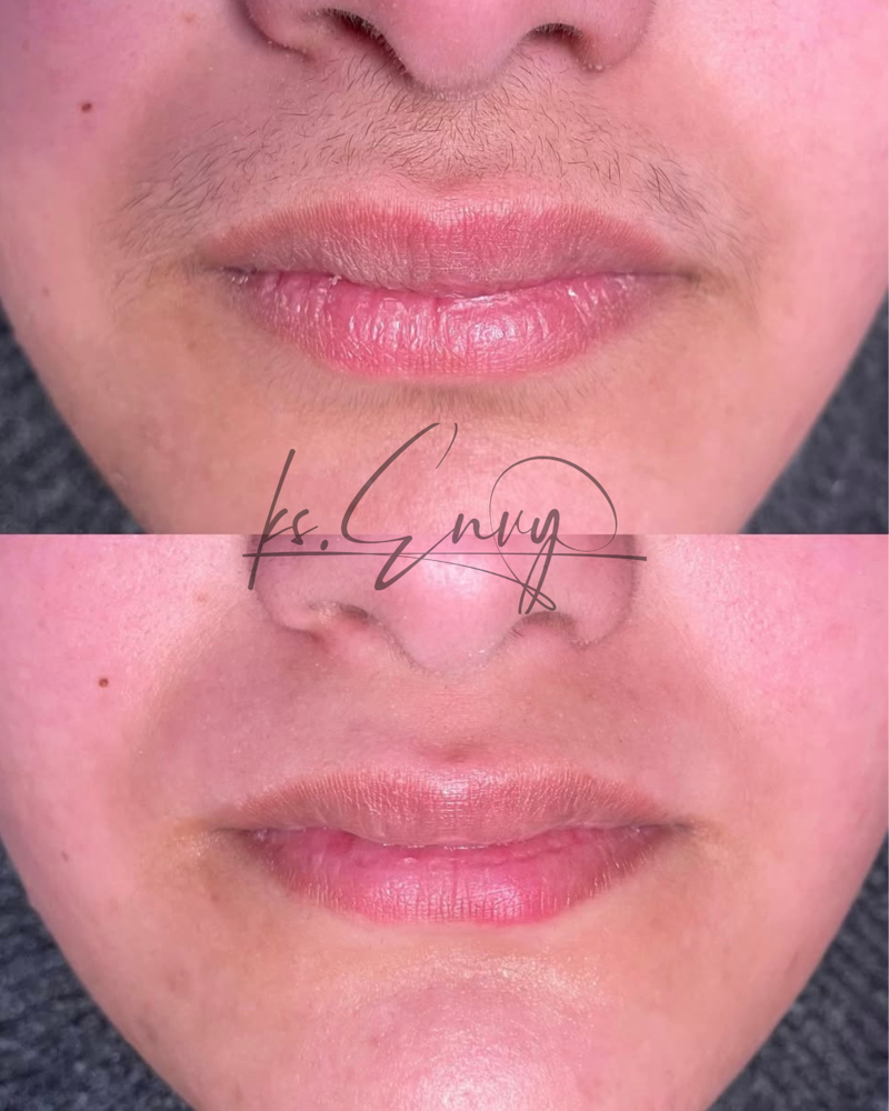 Face: Lip (Upper) at KS.Envy in Columbus, OH