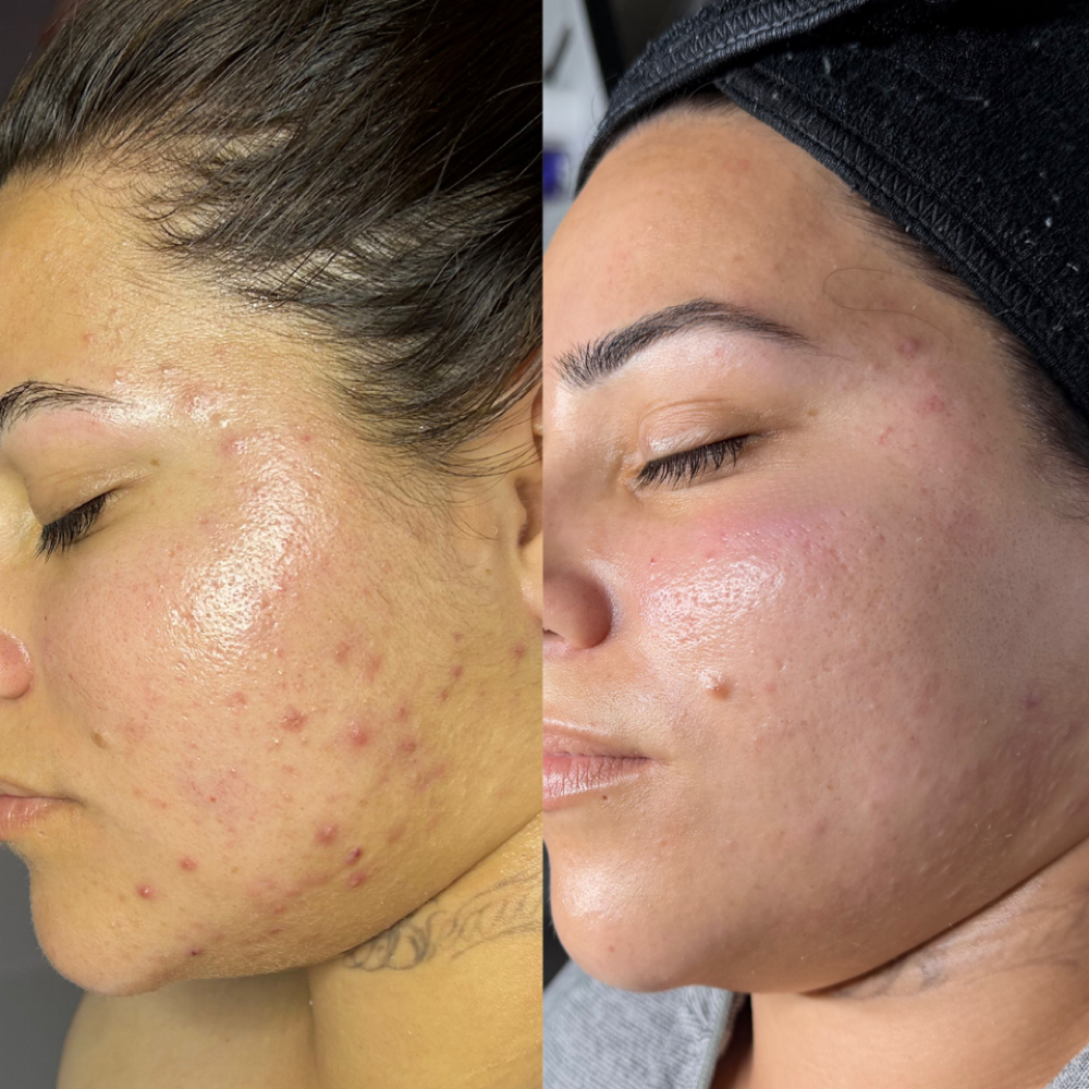 Enhanced Acne Method at Enhanced Esthetics in Merced, CA