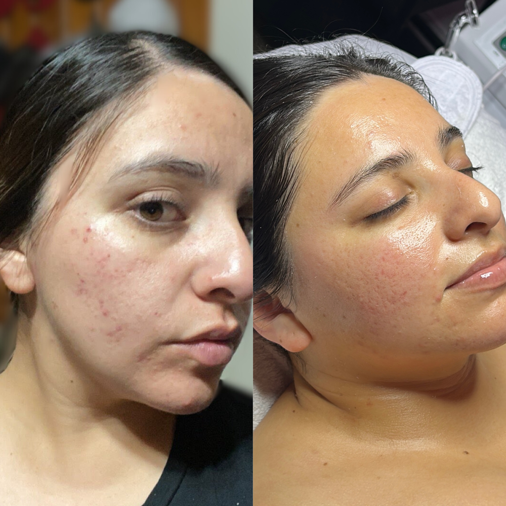 Acne BootCamp