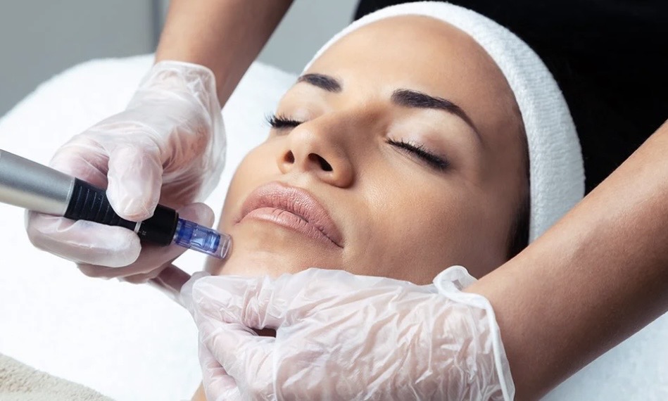 Collagen Induction Therapy at ReNew in Fort Lauderdale, FL