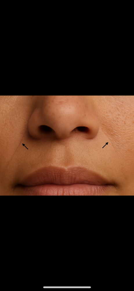 Nasolabial (Smile Line) Treatment