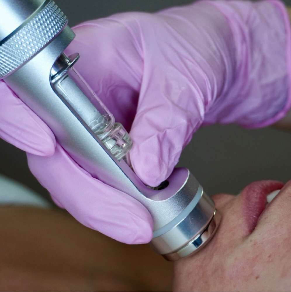 Electroporation at Cora Esthetics in Lubbock, TX