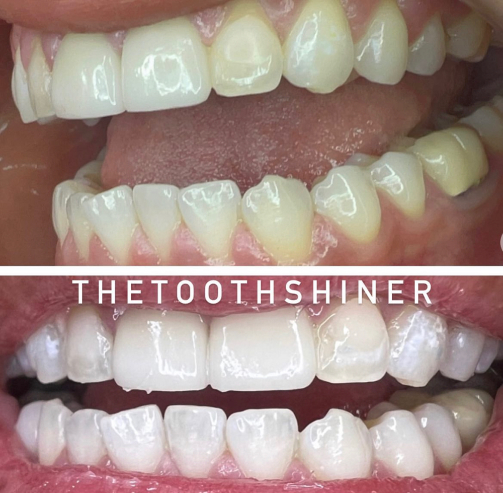 (Touch Up)30Min Pro Laser Whitening