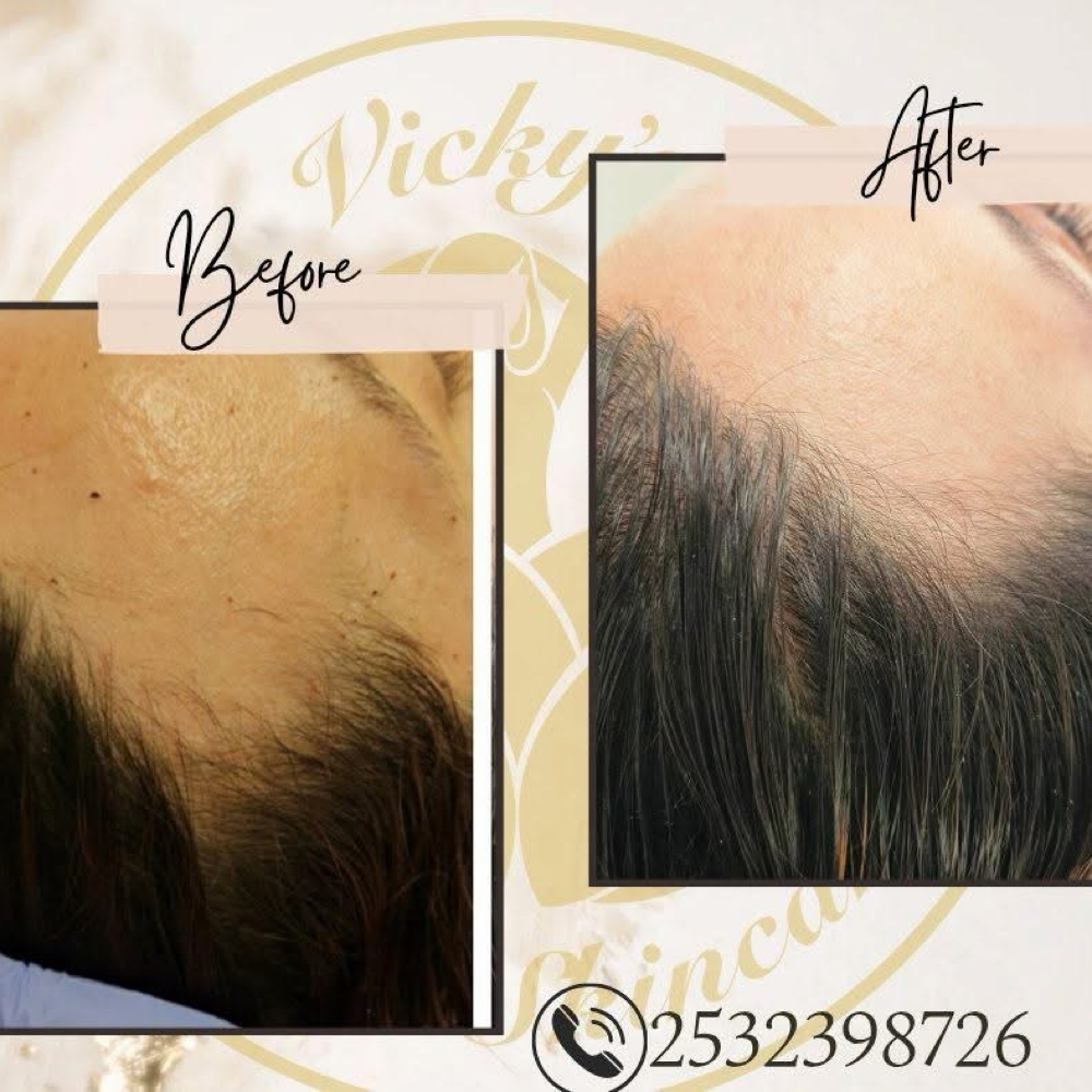 Regeneración Capilar at Vicky's Spa & Skincare LLC in Federal Way, WA