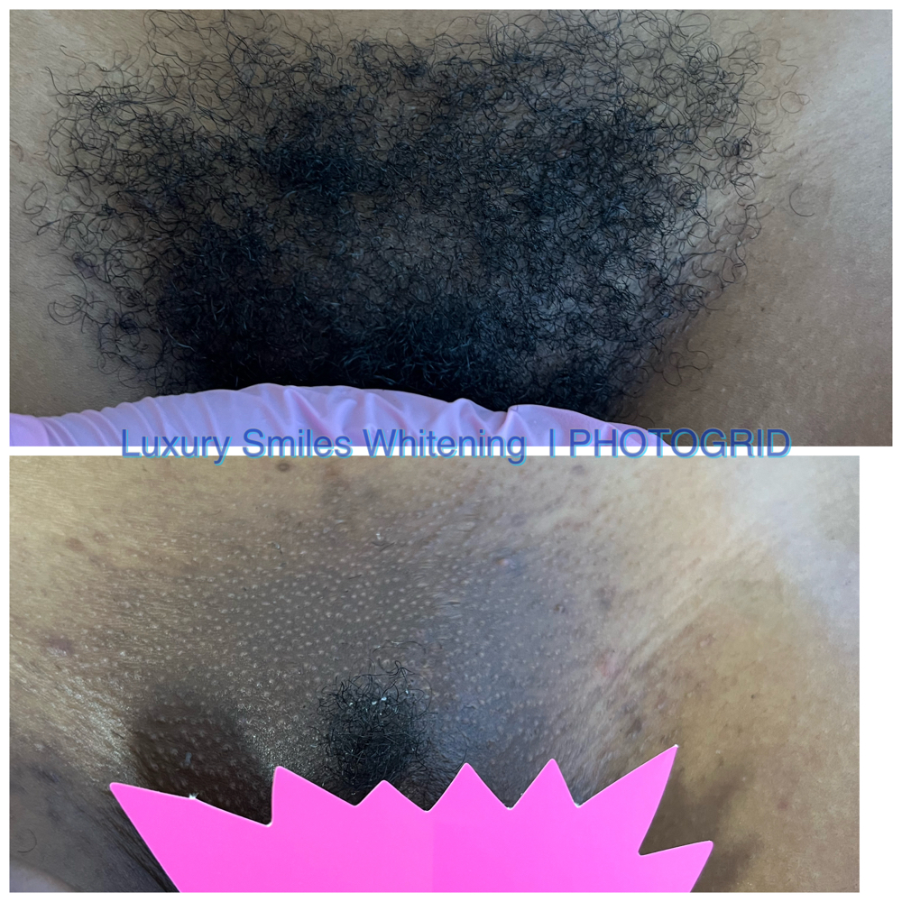 Brazilian Wax *6 Weeks Or More* at Luxury Smiles, Waxes & More in Dallas, TX