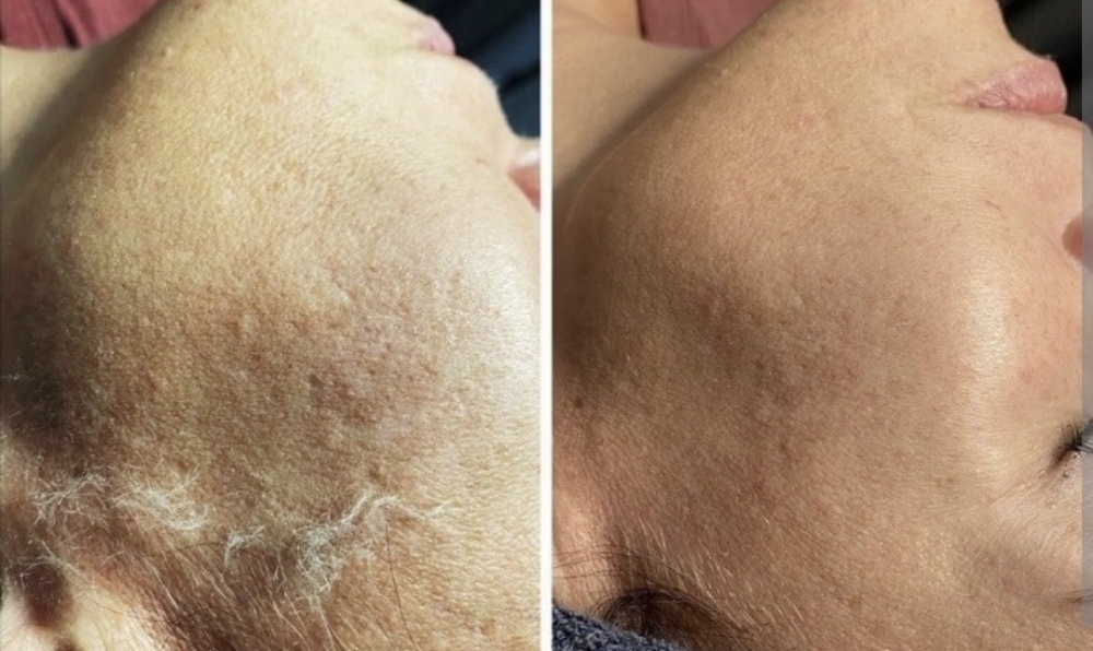 Dermaplaning Add-On To Facial