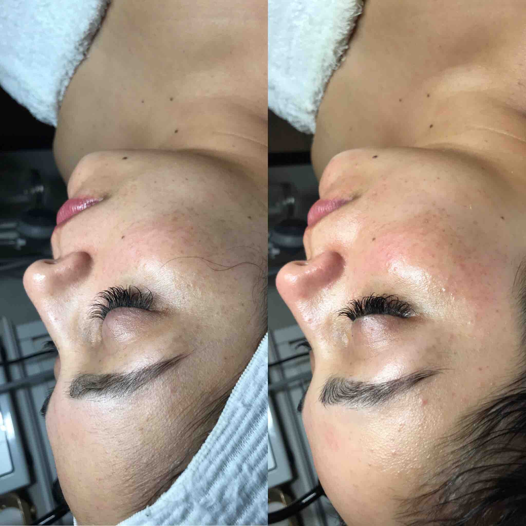 Dermafusion With Face Mask