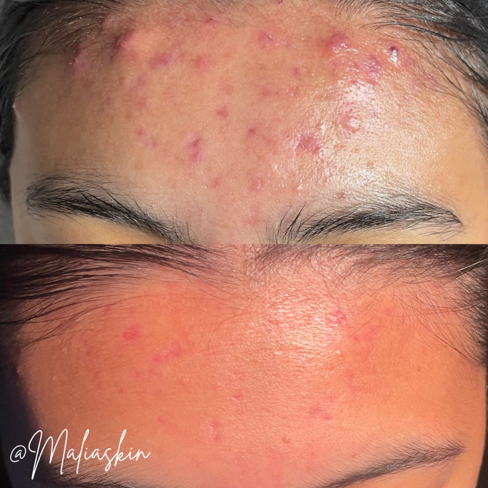 Face Reality Clear Skin Peel