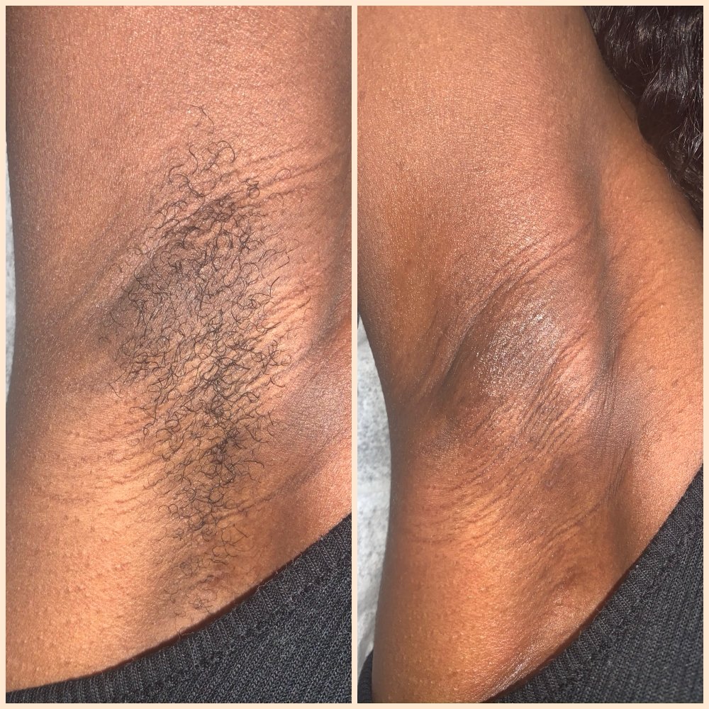 Underarms at Anuyu Beauty Bar in Snellville, GA