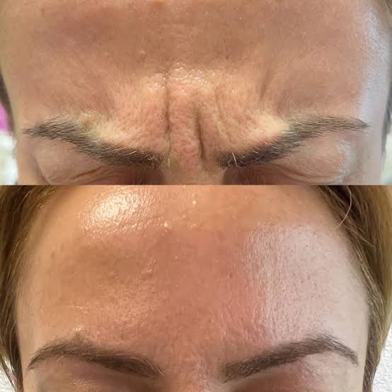 Glabella •Frown Line Treatment• at Glam X Sam MedBeauty in Andrews, TX