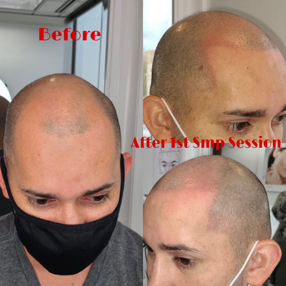 Scalp Micropigmentation( HFS)